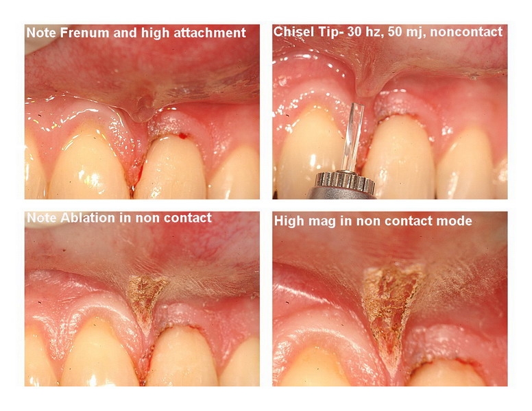 Frenectomy Pg 4 edited_resize.jpg